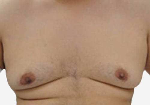 Male Breast Reduction