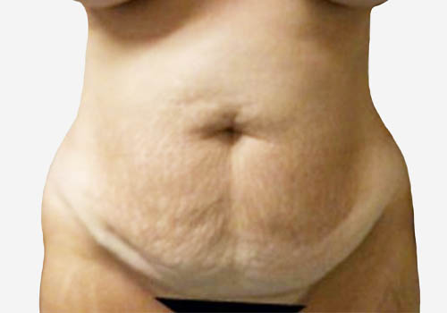 Tummy Tuck