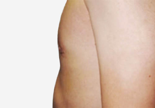 Male Breast Reduction