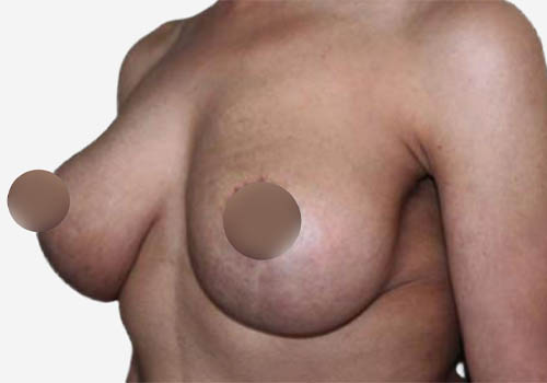 Breast Lift