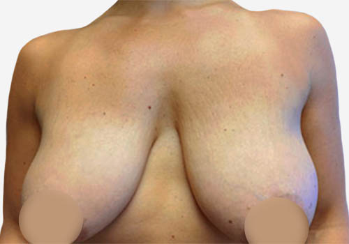 Breast Lift