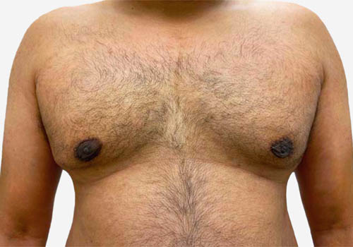 Male Breast Reduction