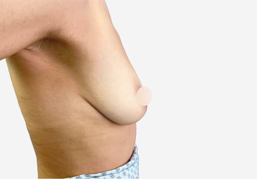 Breast Augmentation