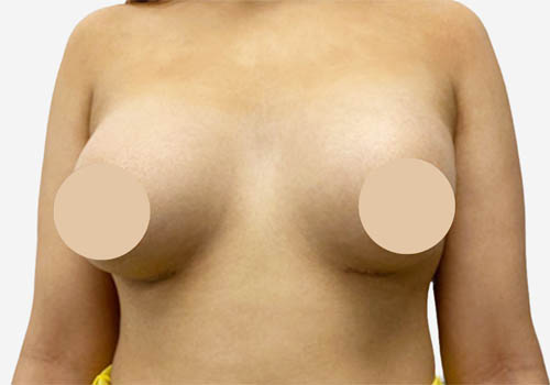 Breast Augmentation