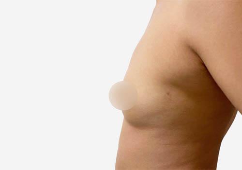 Breast Augmentation