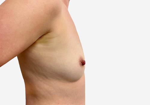 Breast Augmentation