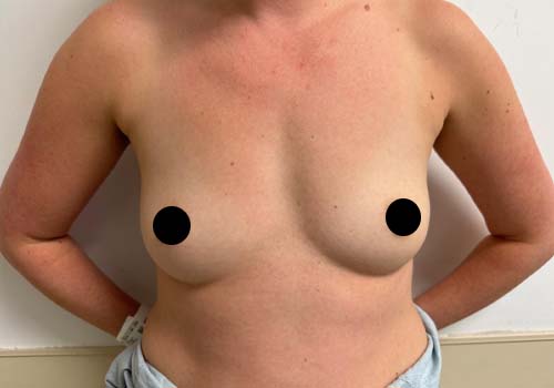 Breast Augmentation