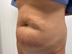 Tummy Tuck