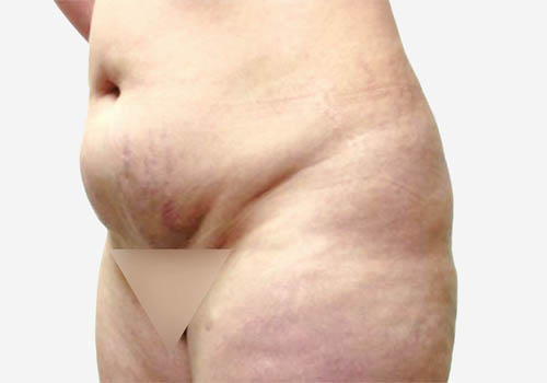 Tummy Tuck