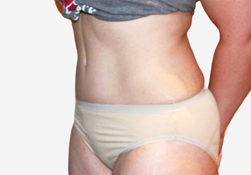 Tummy Tuck