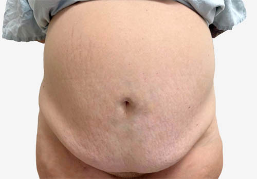 Tummy Tuck