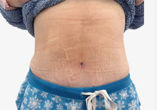 Tummy Tuck