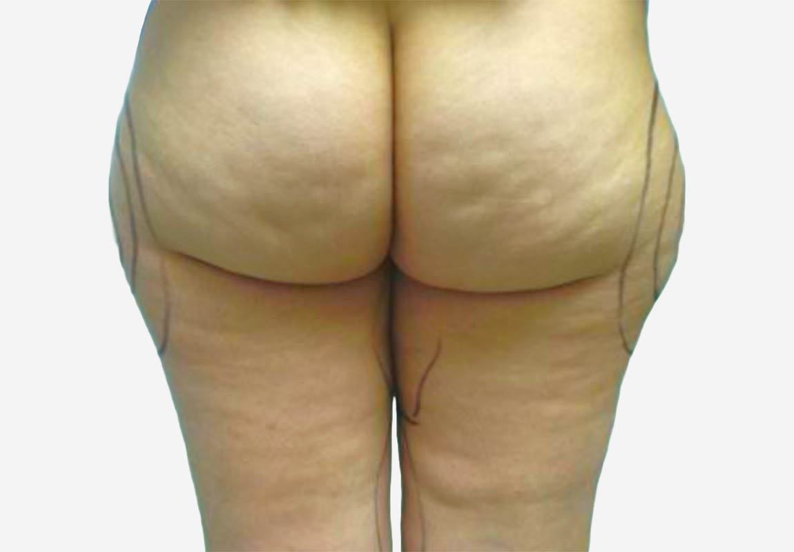 Liposuction