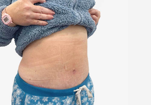 Tummy Tuck