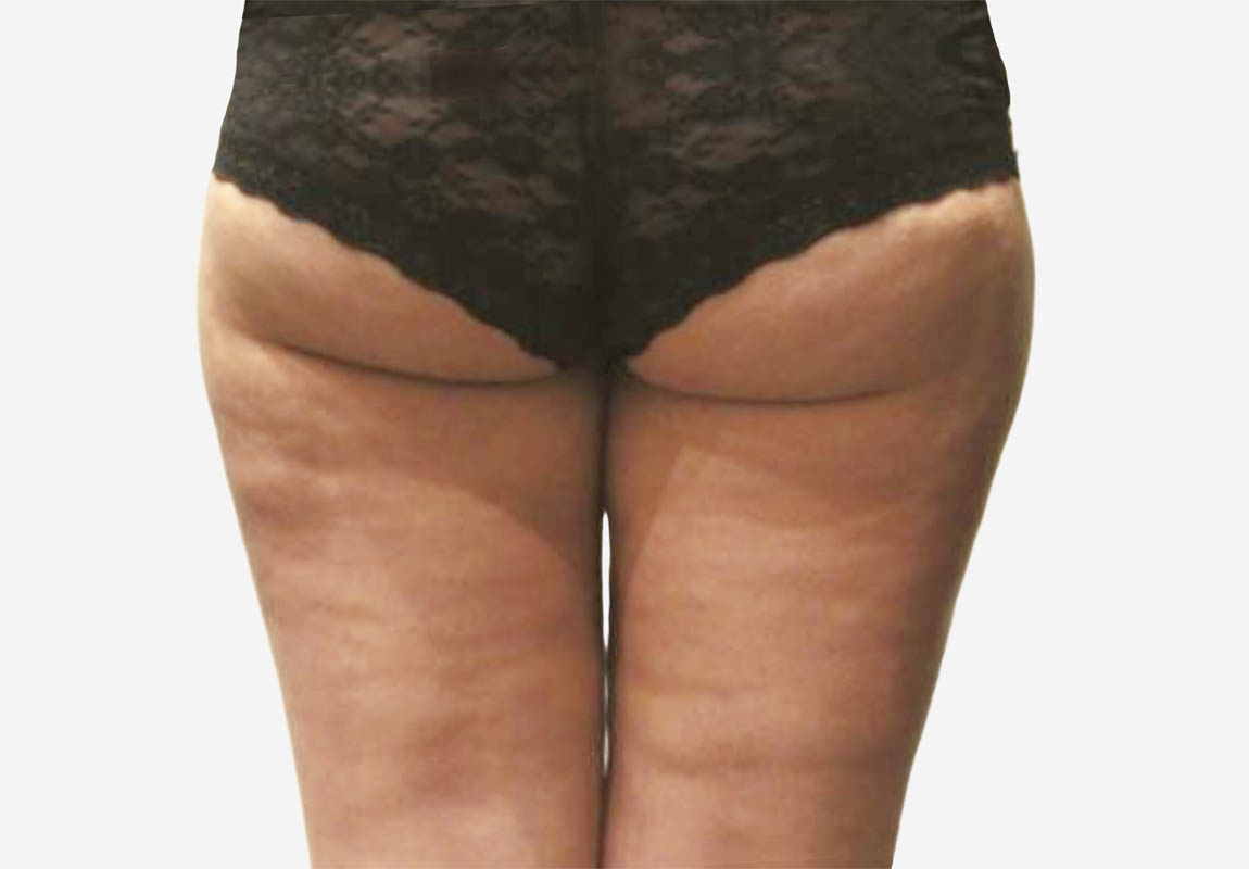 Liposuction