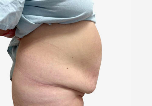 Tummy Tuck