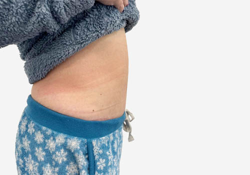 Tummy Tuck