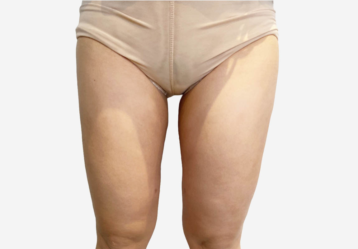 Liposuction