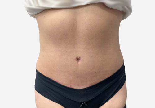 Tummy Tuck