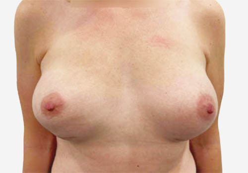 Breast Lift