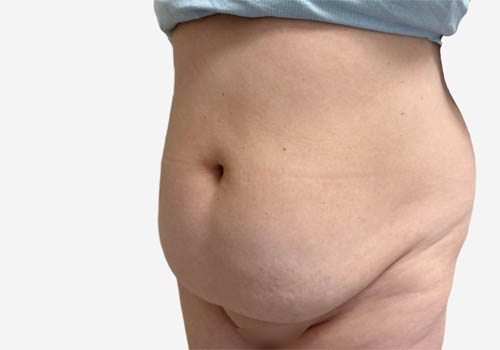 Tummy Tuck