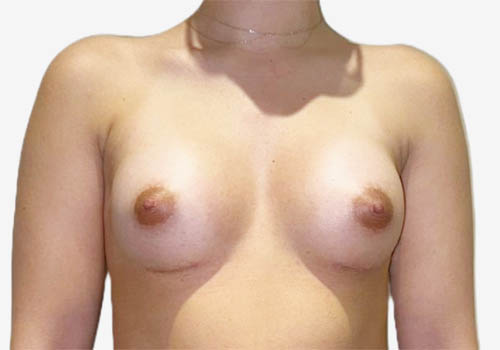 Breast Augmentation
