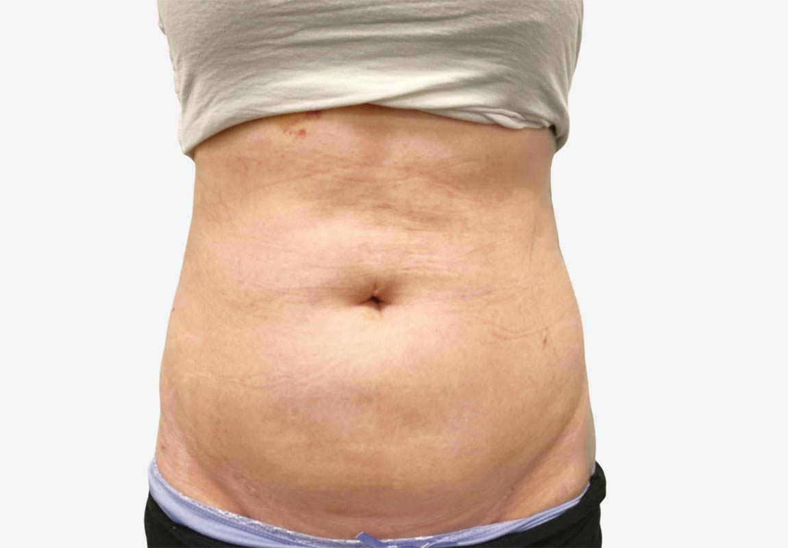 Liposuction