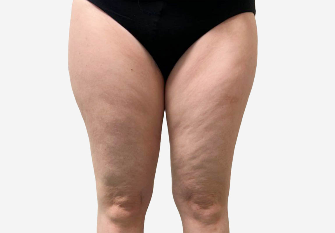 Liposuction