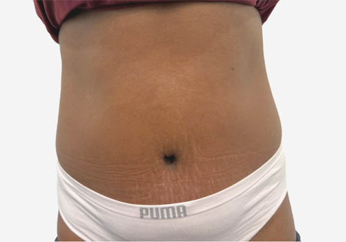 Tummy Tuck