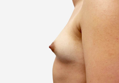 Breast Augmentation