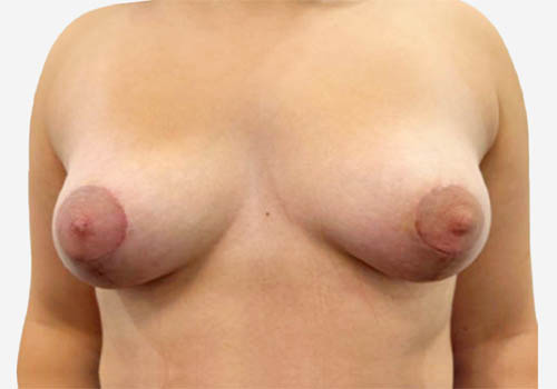 Breast Lift