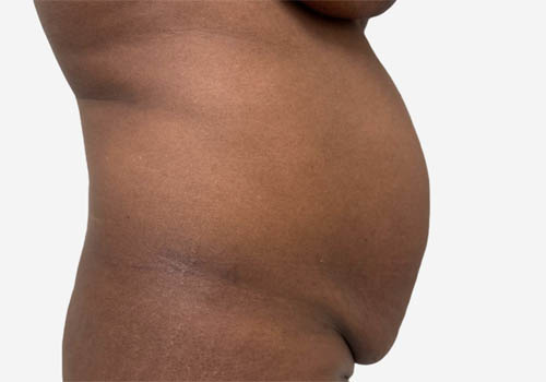 Tummy Tuck