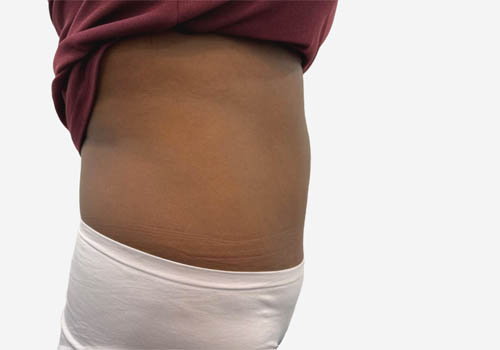 Tummy Tuck