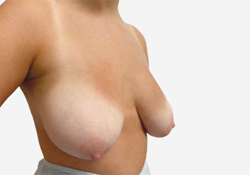 Breast Lift