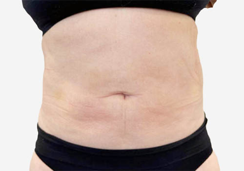 Liposuction
