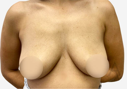 Breast Augmentation