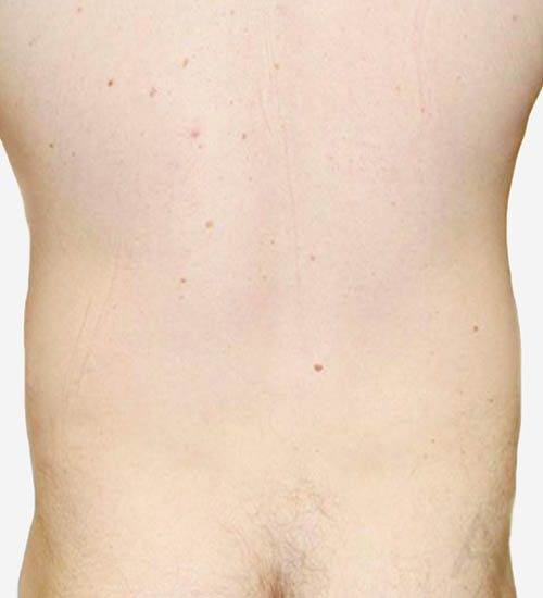 Liposuction