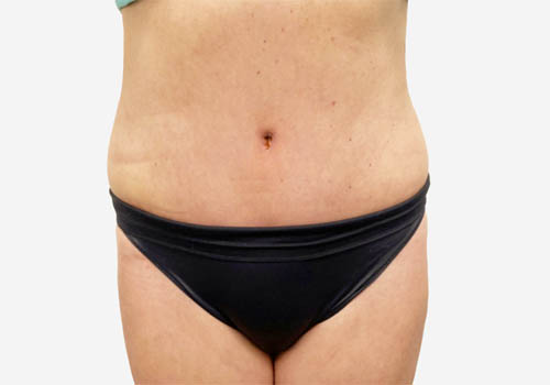 Tummy Tuck