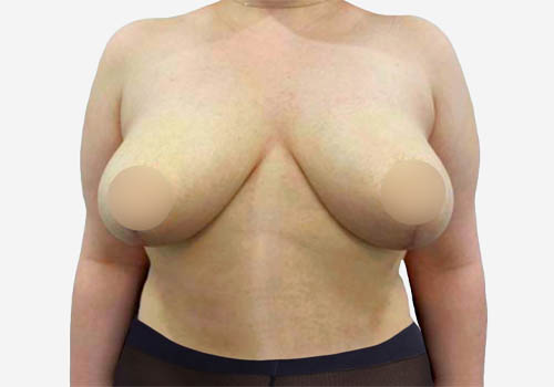 Breast Lift