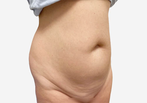Tummy Tuck