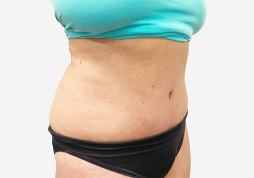 Tummy Tuck
