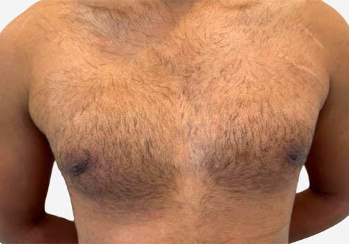 Male Breast Reduction