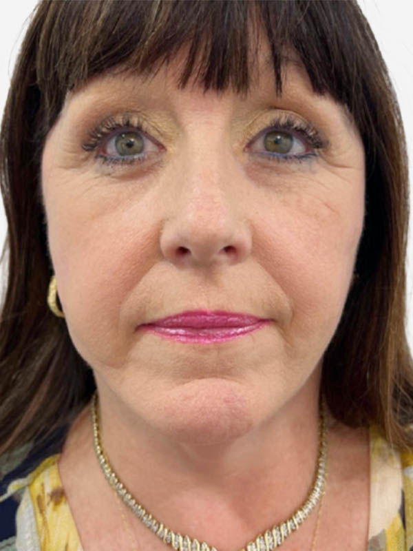 Face & Neck Lift