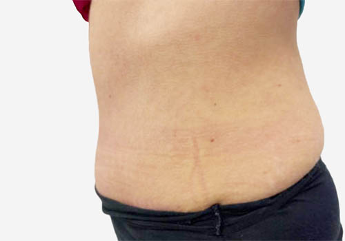 Tummy Tuck