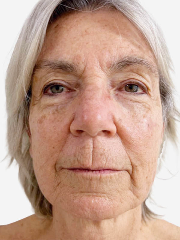 Face & Neck Lift