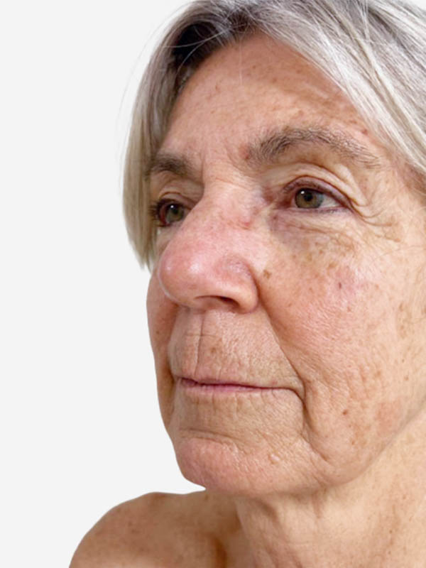 Face & Neck Lift
