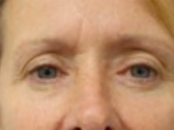 Face & Neck Lift