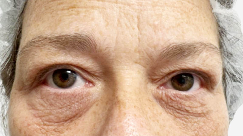 Eyelid Surgery