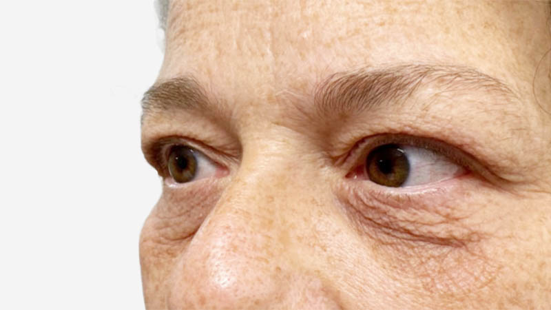 Eyelid Surgery