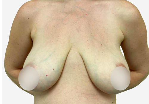Breast Lift